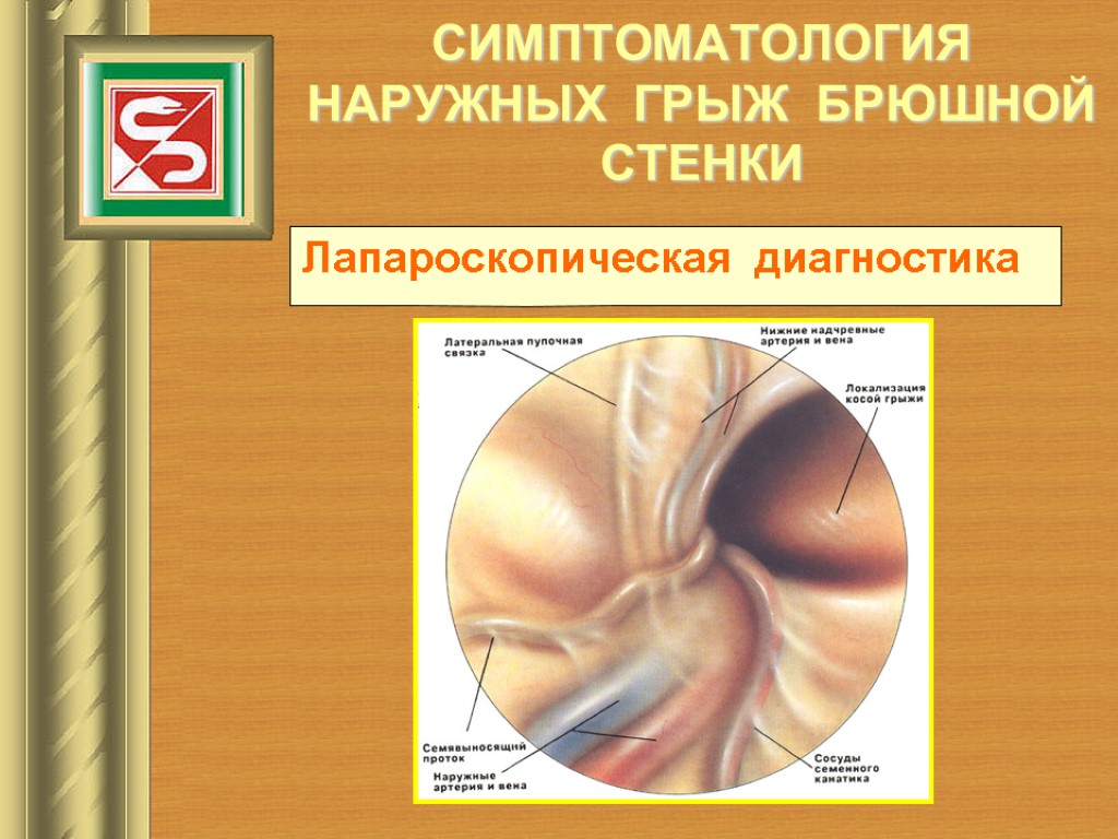 СИМПТОМАТОЛОГИЯ НАРУЖНЫХ ГРЫЖ БРЮШНОЙ СТЕНКИ Лапароскопическая диагностика